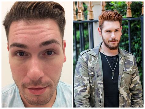 botox cabelo masculino antes e depois